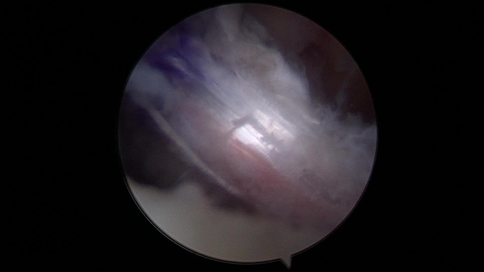 Knee ligament after repair